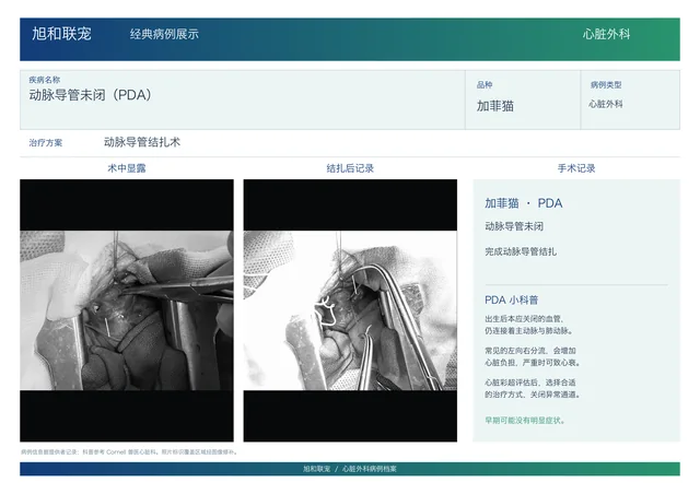 动脉导管未闭 · 科普与手术记录病例展示图