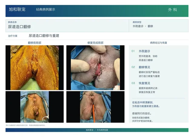 尿道造口翻修病例展示图