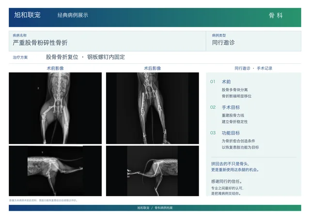严重股骨粉碎性骨折病例展示图